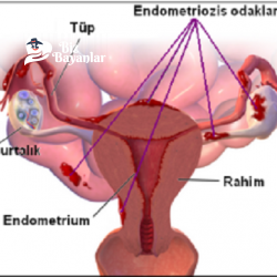 Endometriozis